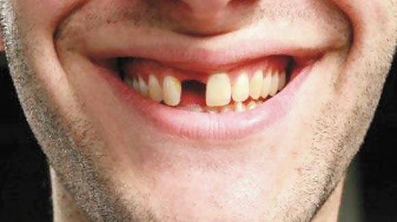 Recuperados da COVID-19 estão relatando perda de dentes saudáveis